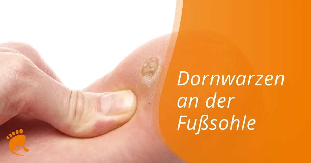 Nahaufnahme einer Fußsohle mit einer sichtbaren Dornwarze. Eine Person drückt mit ihrem Finger auf die Warze. Der Text in deutscher Sprache lautet: Dornwarzen an der Fußsohle.