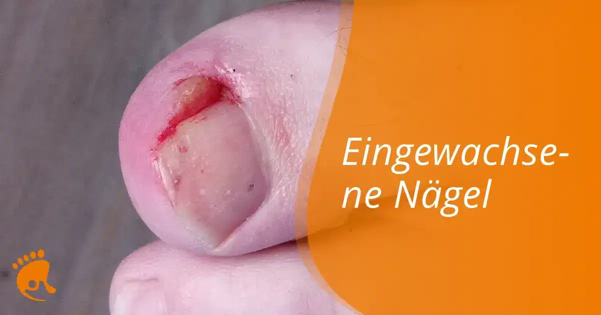 Großaufnahme eines Zehs mit eingewachsenem Nagel und entzündeter Haut, daneben orangefarbener Bereich mit dem Text 'Eingewachsene Nägel'