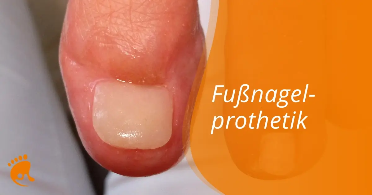 Nahaufnahme eines großen Zehs mit künstlicher Fußnagelprothese, daneben der Schriftzug 'Fußnagelprothetik' auf orangefarbenem Hintergrund