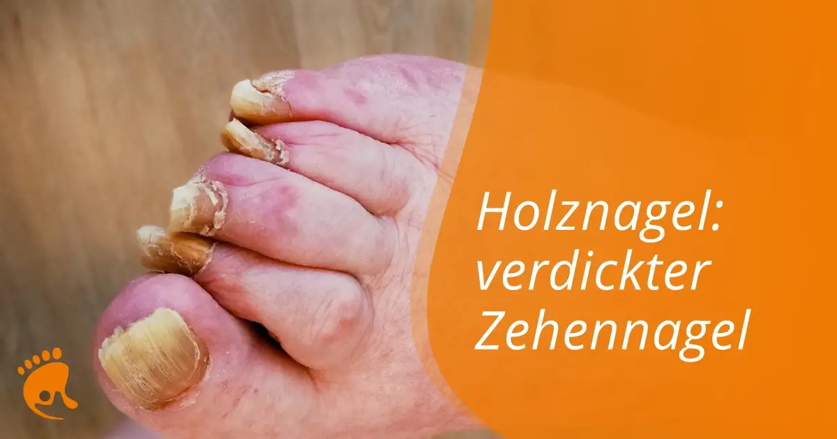 Nahaufnahme eines Fußes mit verdicktem, verfärbtem großen Zehennagel und weiteren Zehennägeln mit Nagelveränderungen, daneben Text 'Holznagel: verdickter Zehennagel'.