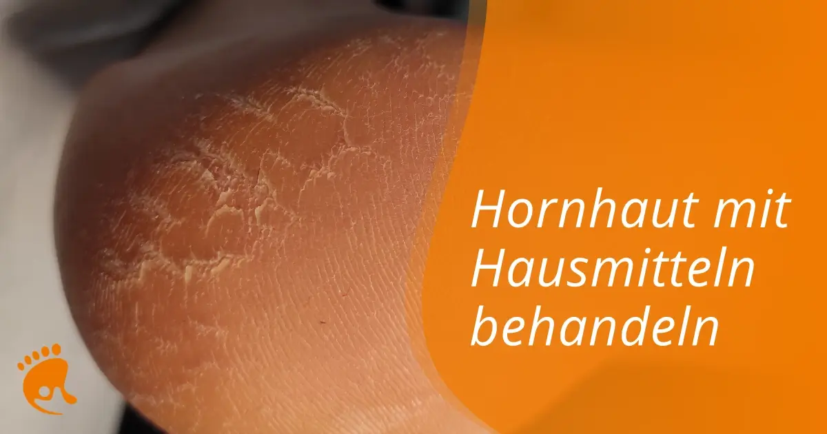 Nahaufnahme einer trockenen, rissigen Hornhaut an der Ferse mit dem Text 'Hornhaut mit Hausmitteln behandeln' auf orangefarbenem Hintergrund