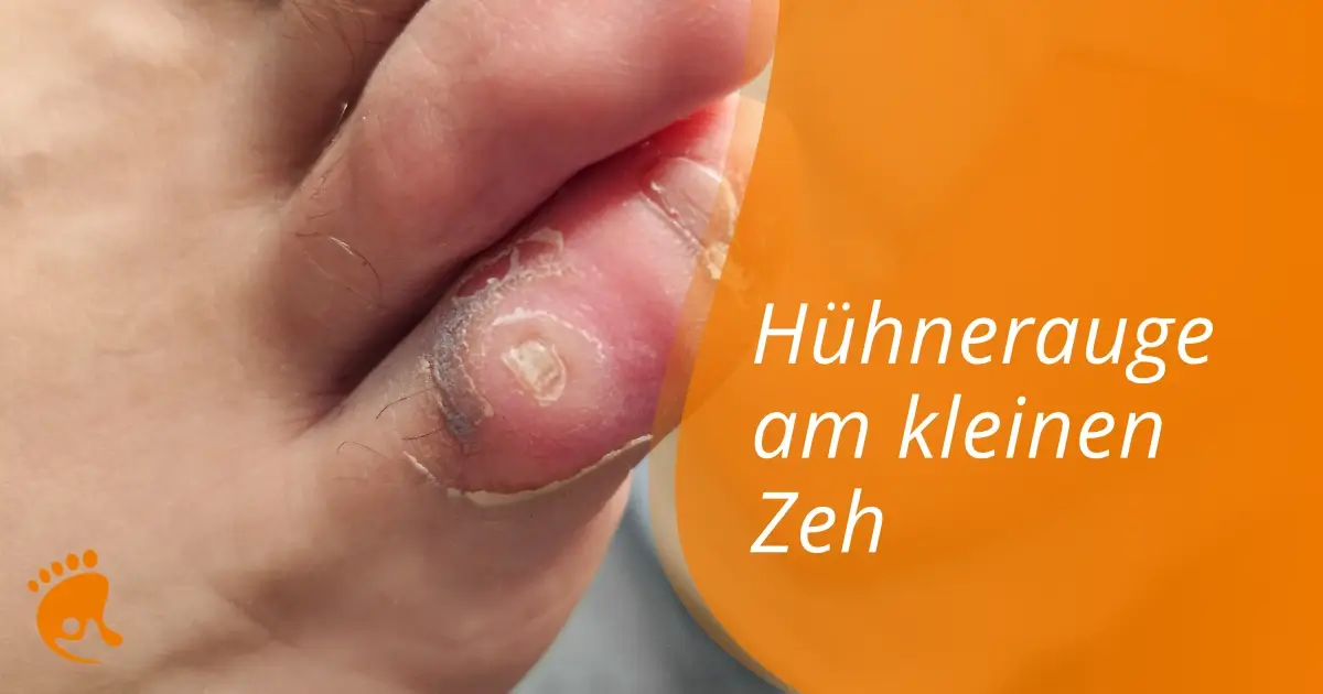 Nahaufnahme eines kleinen Zehs mit einem Hühnerauge und trockener, rissiger Haut, daneben der Text 'Hühnerauge am kleinen Zeh' auf orangefarbenem Hintergrund.