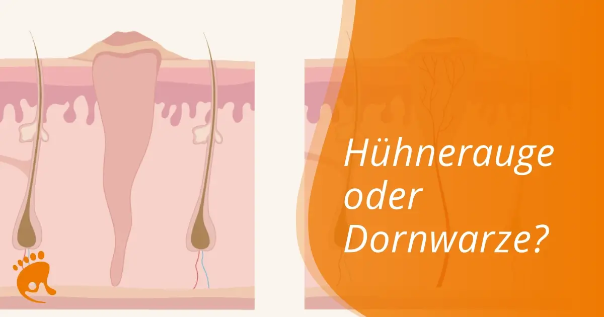 Querschnitt der Haut mit Haarfollikeln und einer verdickten, hornigen Stelle, daneben Text 'Hühnerauge oder Dornwarze?'