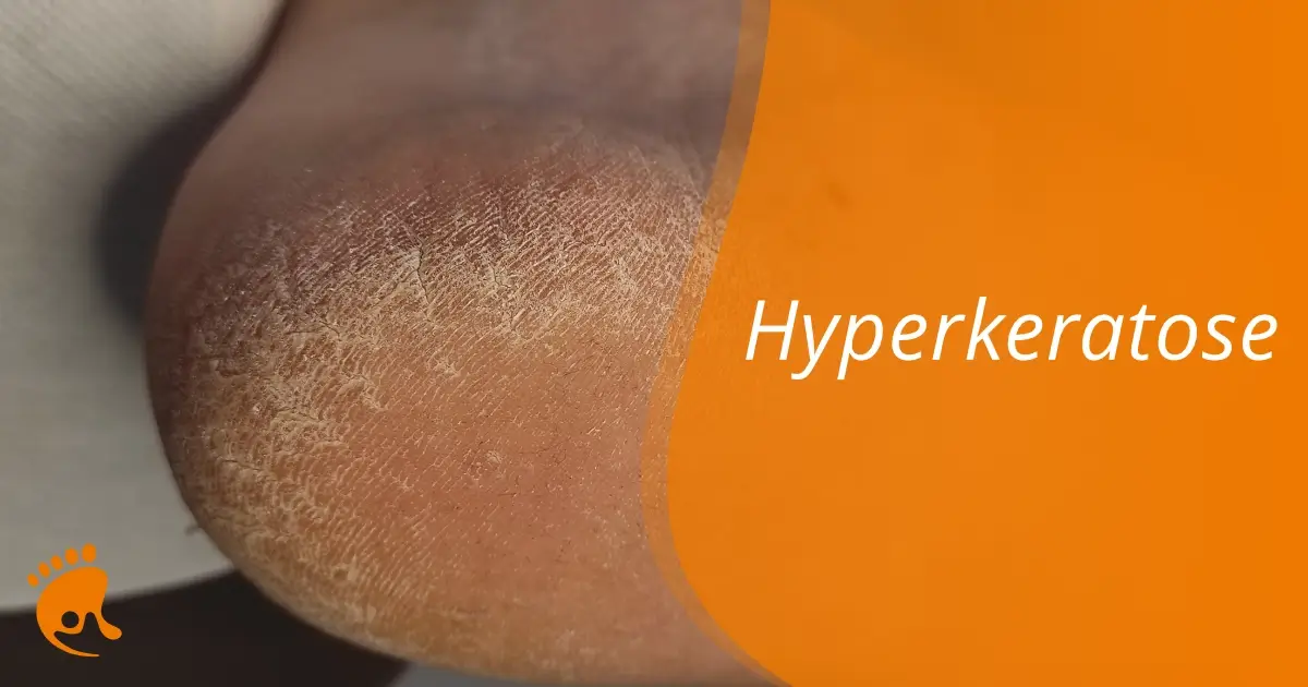 Nahaufnahme einer trockenen, rissigen Fersenhaut mit dem Schriftzug 'Hyperkeratose' auf orangefarbenem Hintergrund