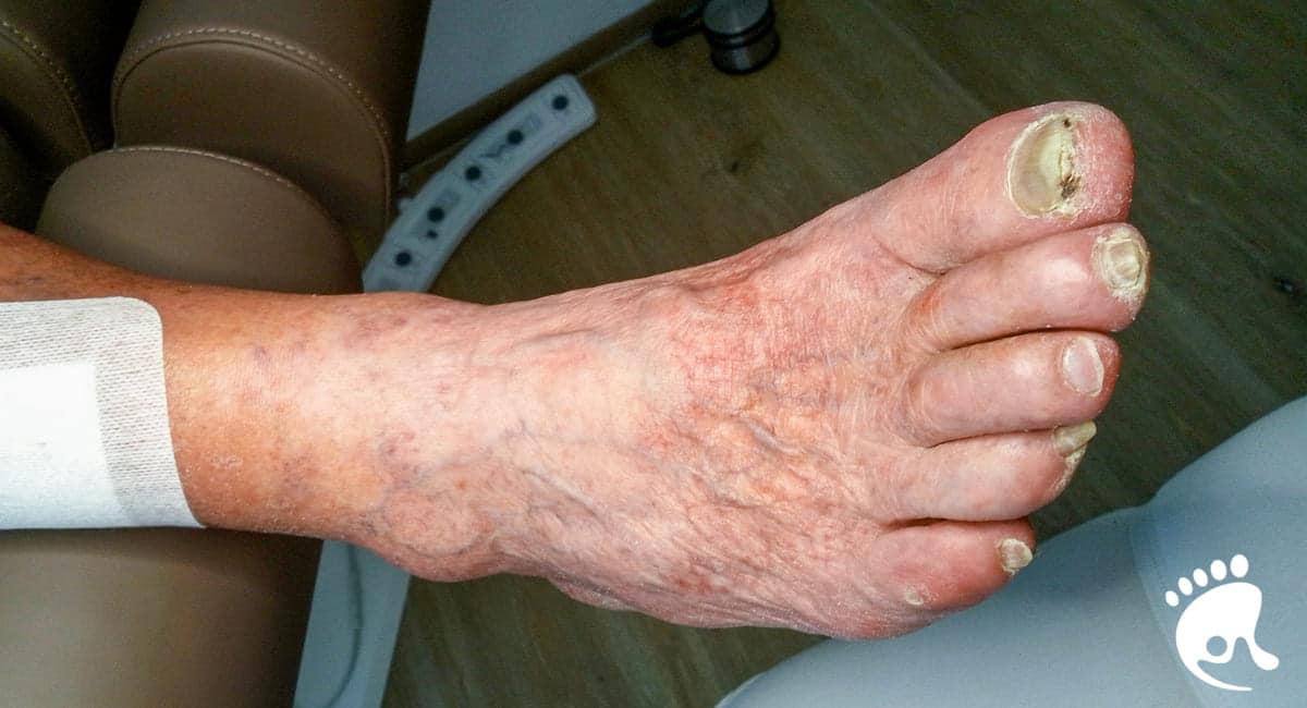 Ein Fuß einer älteren Person mit verdickten, verfärbten Zehennägeln und trockener, faltiger Haut ruht auf einem braunen Stuhl. Auf dem Unterschenkel ist ein weißer Pflasterverband zu sehen.