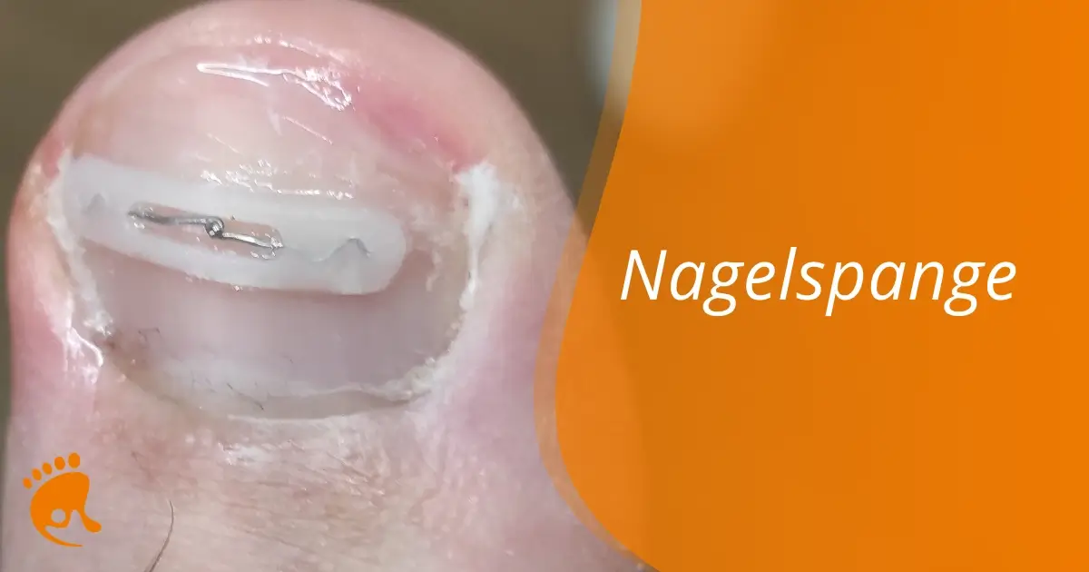 Fußnagel mit aufgeklebter Nagelspange zur Korrektur der Nagelform, rechts daneben der Schriftzug 'Nagelspange' auf orangefarbenem Hintergrund.