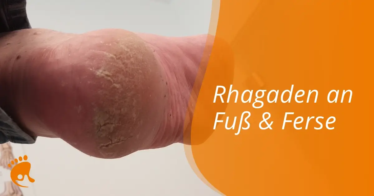 Nahaufnahme einer trockenen, rissigen Ferse mit sichtbaren Hautschuppen, daneben Text 'Rhagaden an Fuß & Ferse' auf orangefarbenem Hintergrund