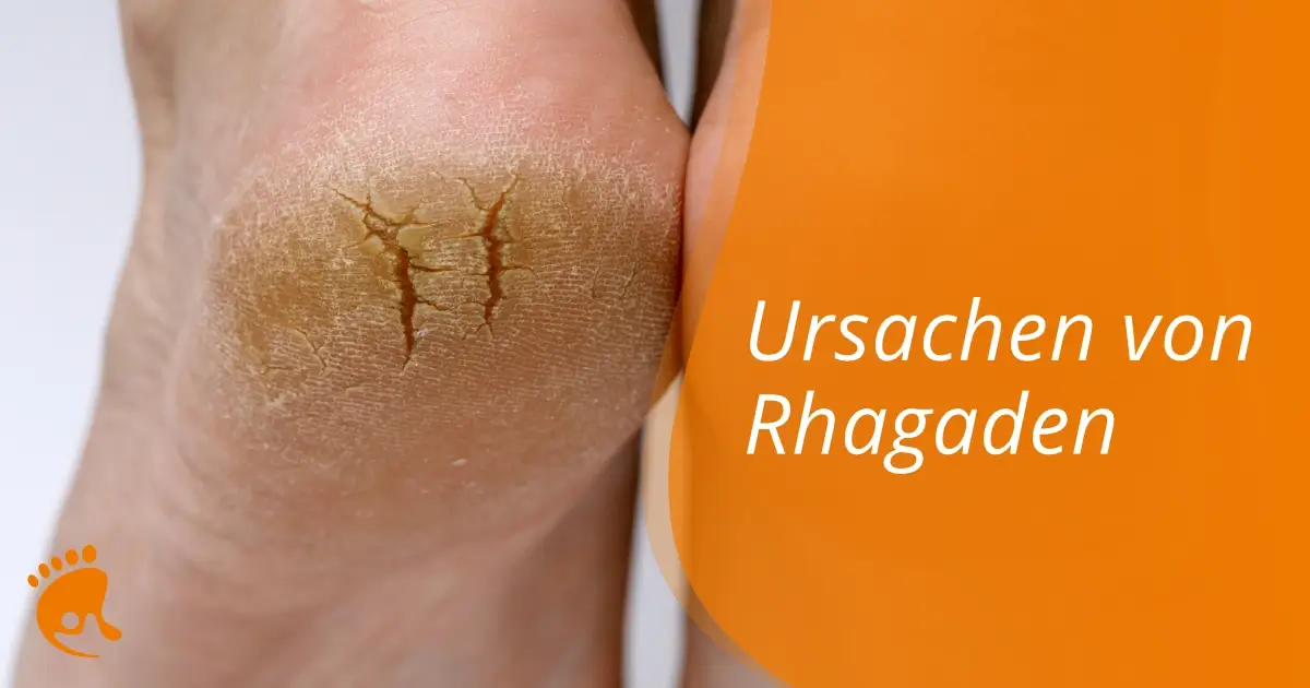 Nahaufnahme von rissigen, trockenen Fersen an nackten Füßen neben dem deutschen Text: Ursachen von Rhagaden