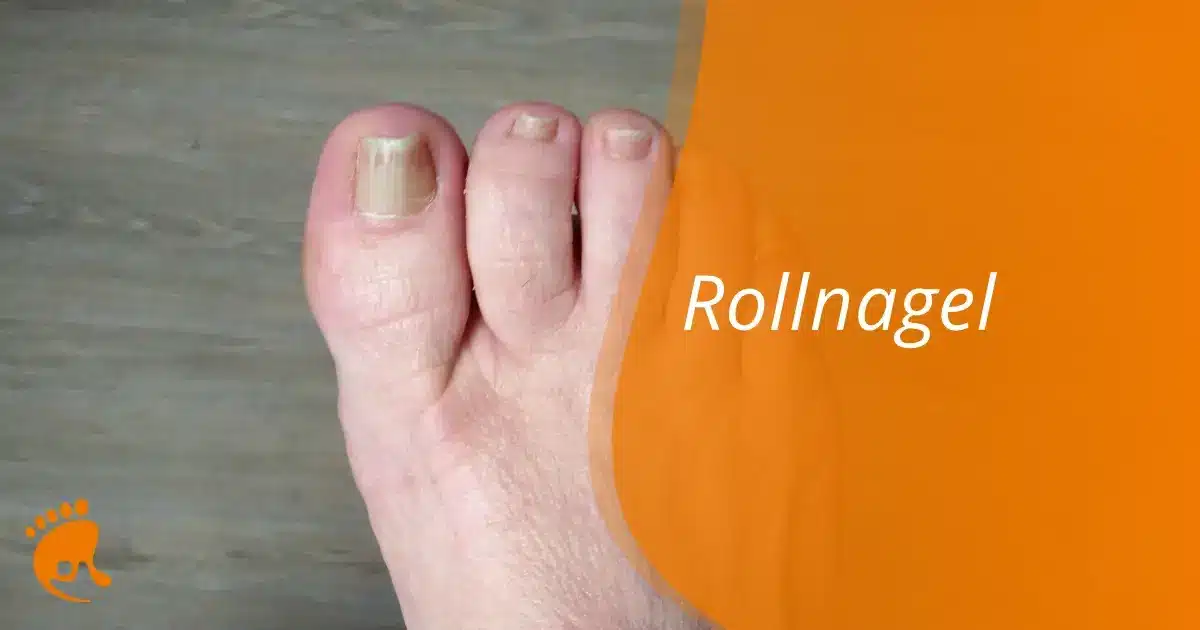Roll­na­gel: Ursa­chen, Sym­pto­me & Behandlung