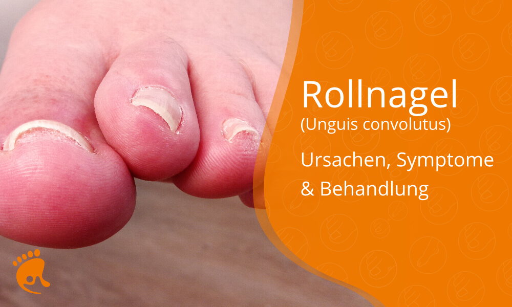 Rollnagel: Ursachen, Symptome & Behandlung